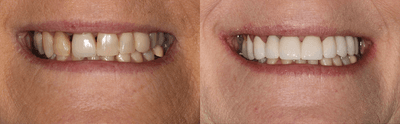 Case 10741 - 45-54 year old woman treated with Dental Crown