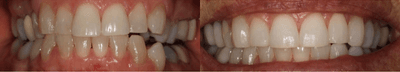Case 10742 - 55-64 year old woman treated with Dental Crown