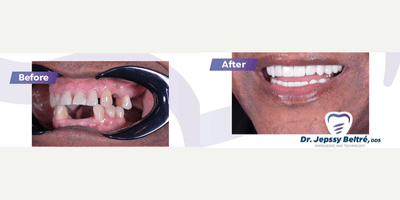 Case 10743 - 65-74 year old man treated with Dental Crown
