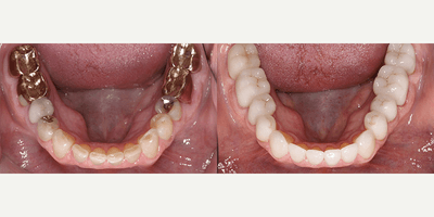 Case 10744 - 35-44 year old woman treated with Dental Crown