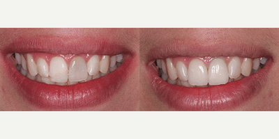 Case 10745 - 35-44 year old woman treated with Dental Crown