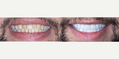 Case 10825 - 35-44 year old man treated with Dental Crown
