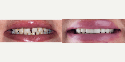 Case 10826 - 55-64 year old woman treated with Dental Crown