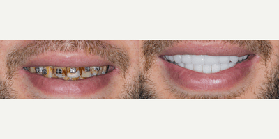 Case 10827 - 35-44 year old man treated with Dental Crown