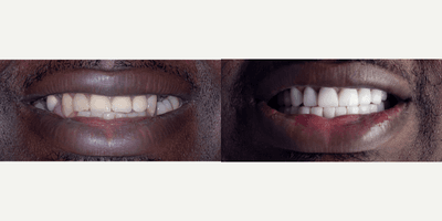 Case 10828 - 45-54 year old man treated with Dental Crown