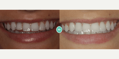Case 10837 - Woman treated with Dental Implants