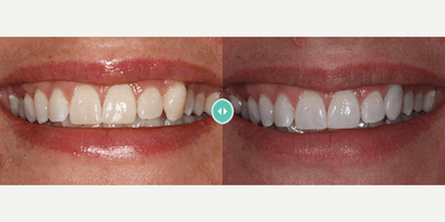 Case 10838 - Woman treated with Dental Implants