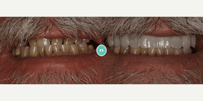 Case 10839 - Man treated with Dental Implants