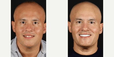 Case 10840 - Man treated with Dental Implants