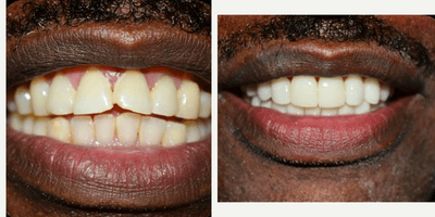 Case 10842 - Man treated with Porcelain Veneers, Dental Implants