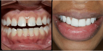 Case 10843 - Man treated with Dental Implants, Porcelain Veneers