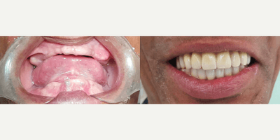 Case 10844 - Man treated with All-on-4 Dental Implants, Dental Implants, Porcelain Veneers