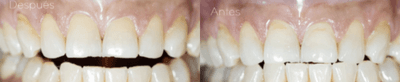 Case 10951 - 45-54 year old woman treated with Dental Bonding