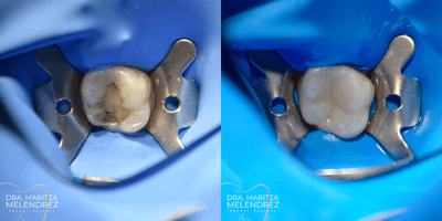 Case 10952 - 18-24 year old woman treated with Dental Bonding