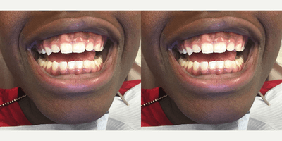 Case 10953 - Laser Gum Lift for 15 year old; Immediate results