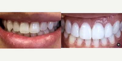 Case 10954 - Woman treated with Porcelain Veneers, Teeth Whitening, Dental Bonding, Smile Makeover
