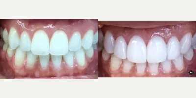 Case 10955 - Woman treated with Dental Bonding, Teeth Whitening, Smile Makeover
