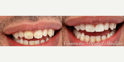 Case 10956 - Man treated with Dental Bonding