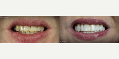 Case 10957 - 35-44 year old woman treated with Dental Bonding, Smile Makeover