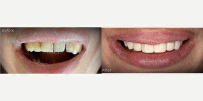 Case 10958 - 25-34 year old woman treated with Dental Bonding