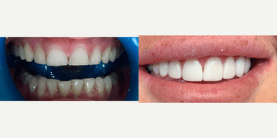 Case 10959 - Georgia Kate, Composite Veneers