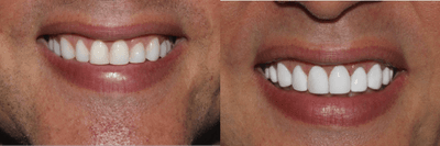 Case 11023 - 35-44 year old man treated with Dental Bonding