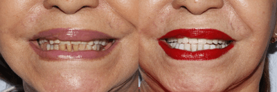 Case 11024 - 55-64 year old woman treated with Dental Bonding