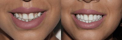 Case 11038 - 25-34 year old woman treated with Dental Bonding