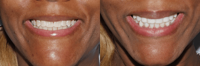 Case 11044 - 35-44 year old woman treated with Dental Bonding