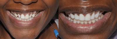 Case 11045 - 25-34 year old woman treated with Dental Bonding