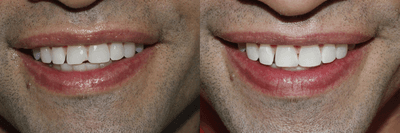 Case 11047 - 35-44 year old man treated with Dental Bonding