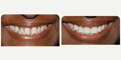 Case 11048 - 35-44 year old woman treated with Dental Bonding