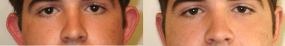 Case 11148 - 25-34 year old man treated with Ear Surgery