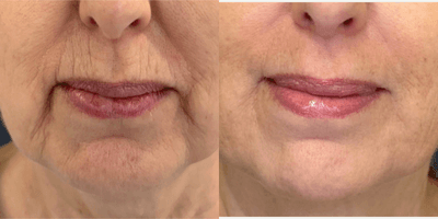Case 11291 - 55-64 year old woman treated with Microneedling RF, Microneedling