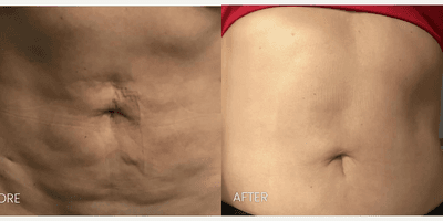 Case 11292 - 45-54 year old woman treated with Secret Pro Radiofrequency Microneedling and CO2