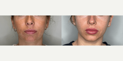 Case 11293 - 25-34 year old woman treated with Microneedling, Chemical Peel