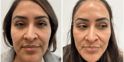 Case 11294 - Woman treated with Microneedling, VI Peel, SkinPen