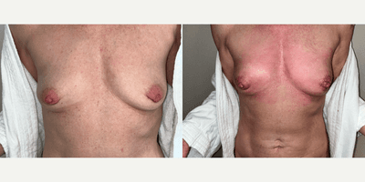 Case 11295 - Woman treated with Microneedling, PRP Injections, for Breast Enhancement