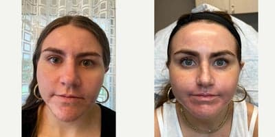 Case 11296 - PERIORAL ACNE SCAR JOURNEY