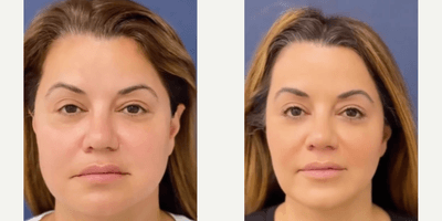 Case 11297 - Woman treated with Microneedling, Buccal Fat Removal
