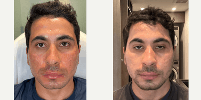 Case 11298 - STACKED ACNE SCAR COMBO