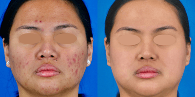 Case 11299 - 25-34 year old woman treated with Accutane, IPL, Skin Tightening, Skin Rejuvenation, Chemical Peel, Microneedling