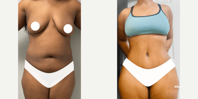 Case 113 - Woman treated with Tummy Tuck