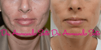 Case 11341 - Woman treated with Microneedling