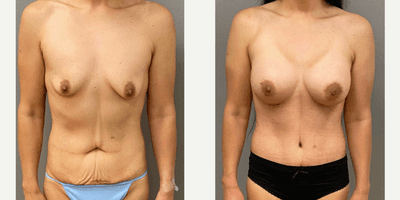 Case 11368 - 35-44 year old woman treated with Tummy Tuck, Mommy Makeover