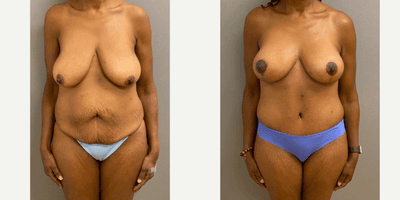 Case 11369 - 55-64 year old woman treated with Breast Lift, Tummy Tuck, Mommy Makeover