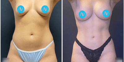 Case 11372 - Woman treated with Mommy Makeover