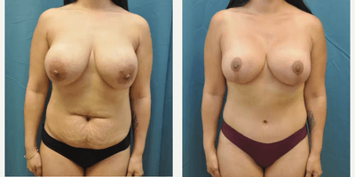 Case 11373 - Woman treated with Mommy Makeover, Tummy Tuck