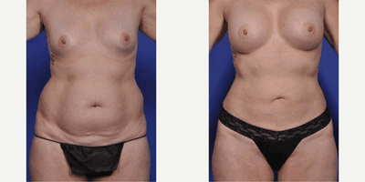 Case 11374 - Woman treated with Mommy Makeover