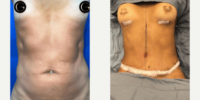 Case 11376 - Woman treated with Breast Augmentation, Tummy Tuck, Mommy Makeover